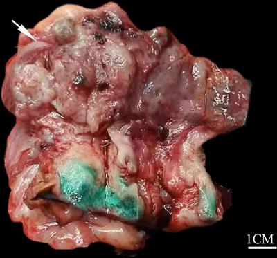 Mesonephric-Like Adenocarcinoma of Uterine Corpus: A Clinicopathological and Targeted Genomic Profiling Study in a Single Institution